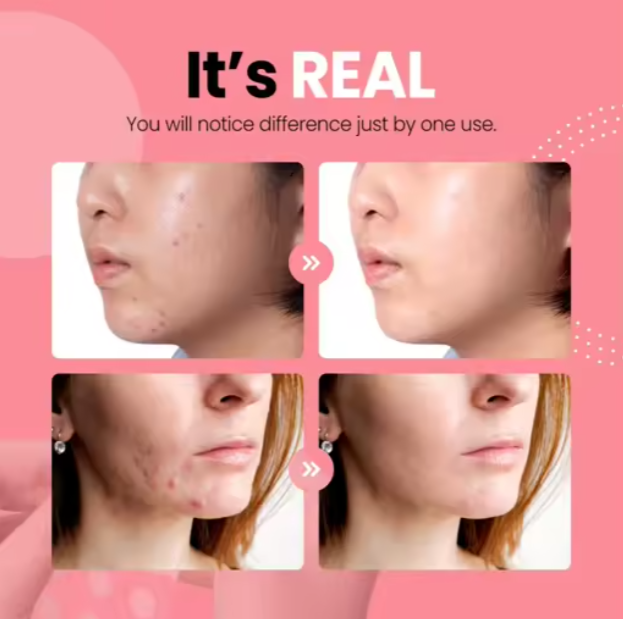 Acne Pimple Patches – 36 Invisible Spot Patches